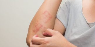 A konsiderohet sëmundja e lëkurës prej të metave sa i përket martesës?