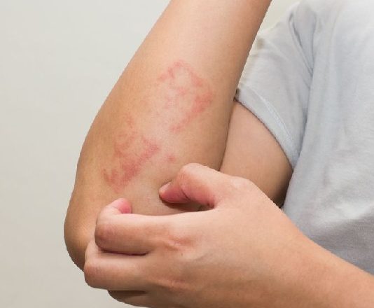 A konsiderohet sëmundja e lëkurës prej të metave sa i përket martesës?