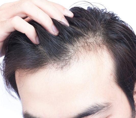 A lejohet transplanti i flokëve?