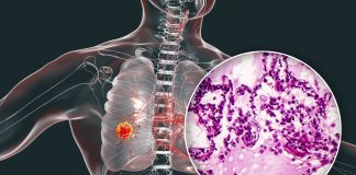 Cili është qëndrimi i sheriatit përkitazi me destinimin e zekatit për shërimin e të sëmurëve nga kanceri?