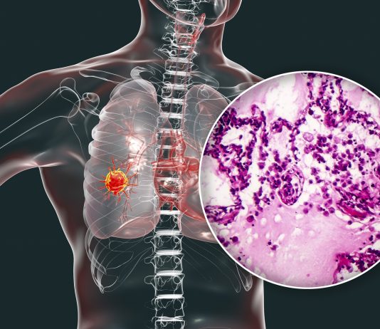 Cili është qëndrimi i sheriatit përkitazi me destinimin e zekatit për shërimin e të sëmurëve nga kanceri?