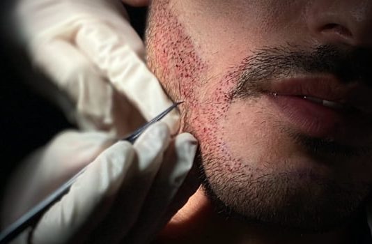 A është hallall transplanti i mjekrës?