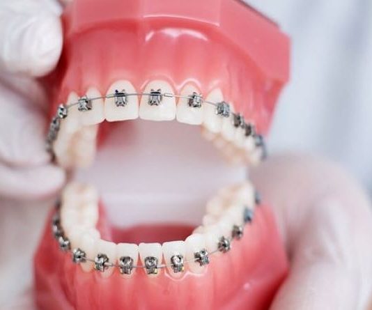 Çfarë gjykimi ka vendosja e protezave për drejtimin e dhëmbëve?