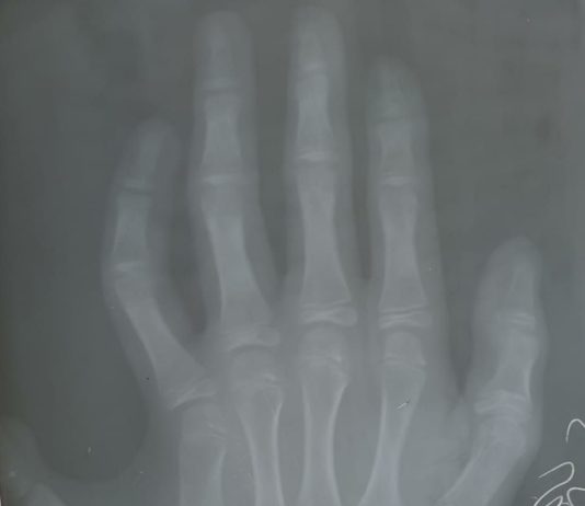 Gjykimi i heqjes (me operim) të gishtit të tepërt nëse fëmija lind me gjashtë gishta